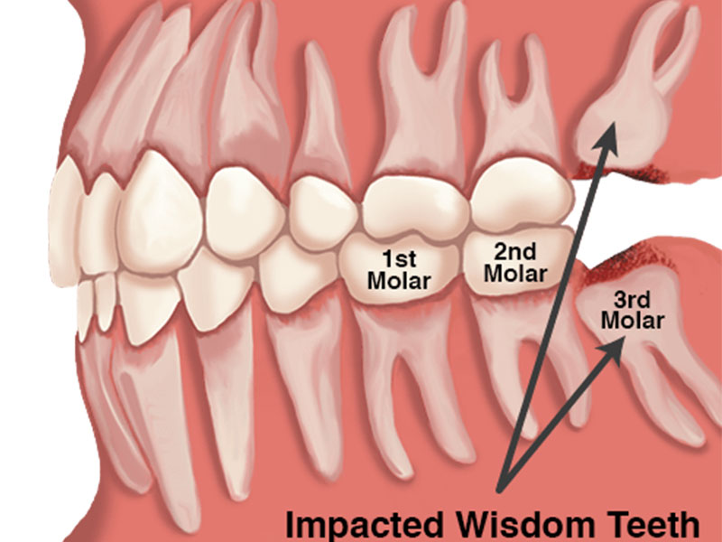 impacted teeth